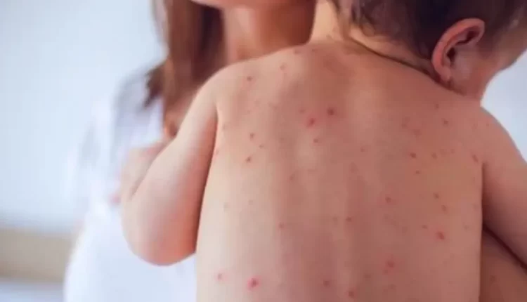 تطوان: وفاة طفلة جراء مضاعفات فيروس الحصبة (بوحمرون)