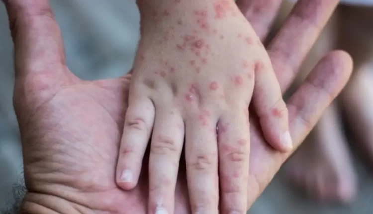 انتشار مرض بوحمرون يثير استنفار المدارس في تطوان